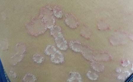 银屑病患者吃偏方