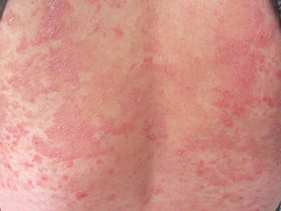 牛皮鲜日常预防