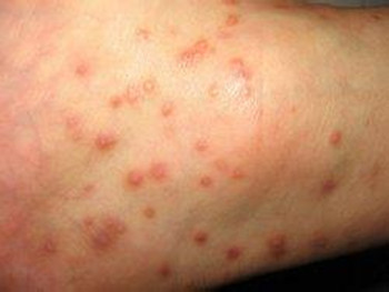 牛皮癣怎么治疗