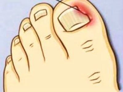 牛皮癣越早治疗越好