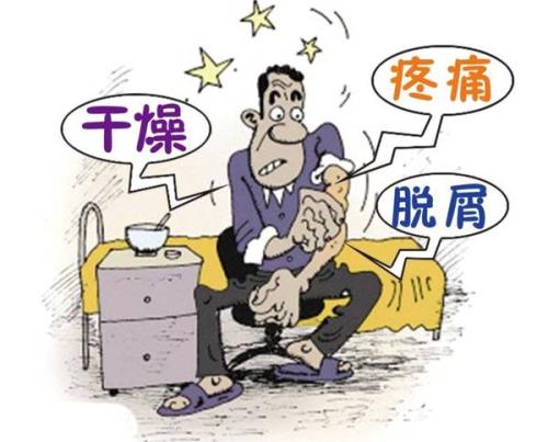 牛皮癣该怎么治疗