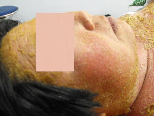 面部牛皮癣护理