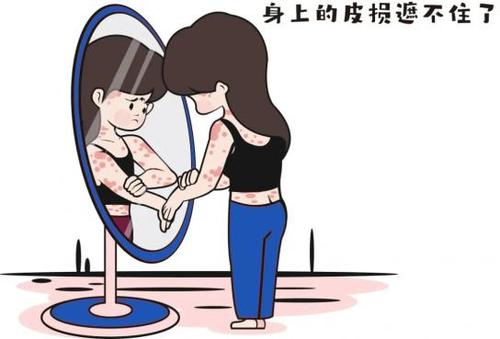 儿童银屑病可以治好吗