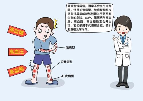 牛皮癣如何用药治疗