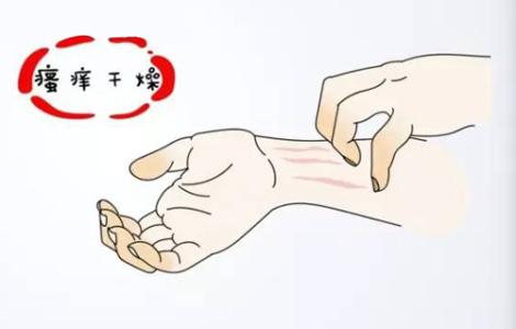 治疗银屑病的药物